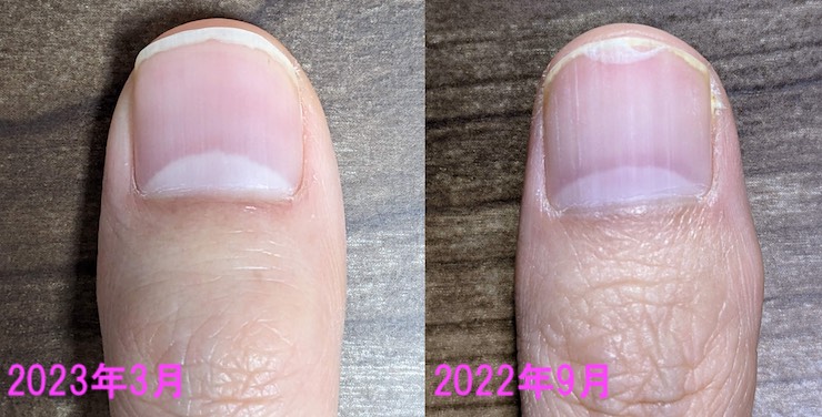親指の爪の比較